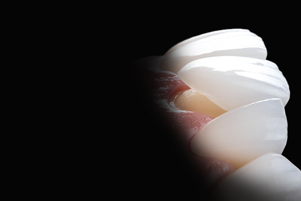 lente de contato dental rafael rosalino odontologia
