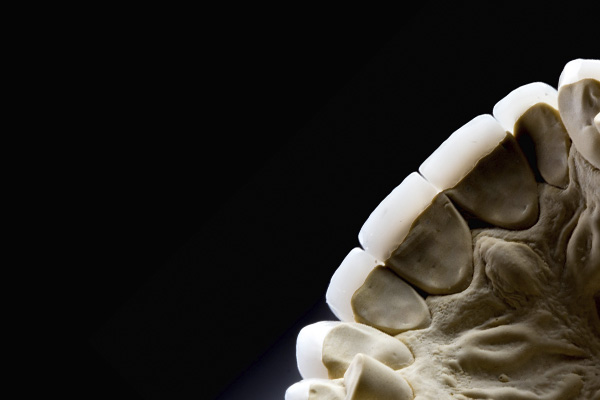 facetas em resina composta rafael rosalino odontologia